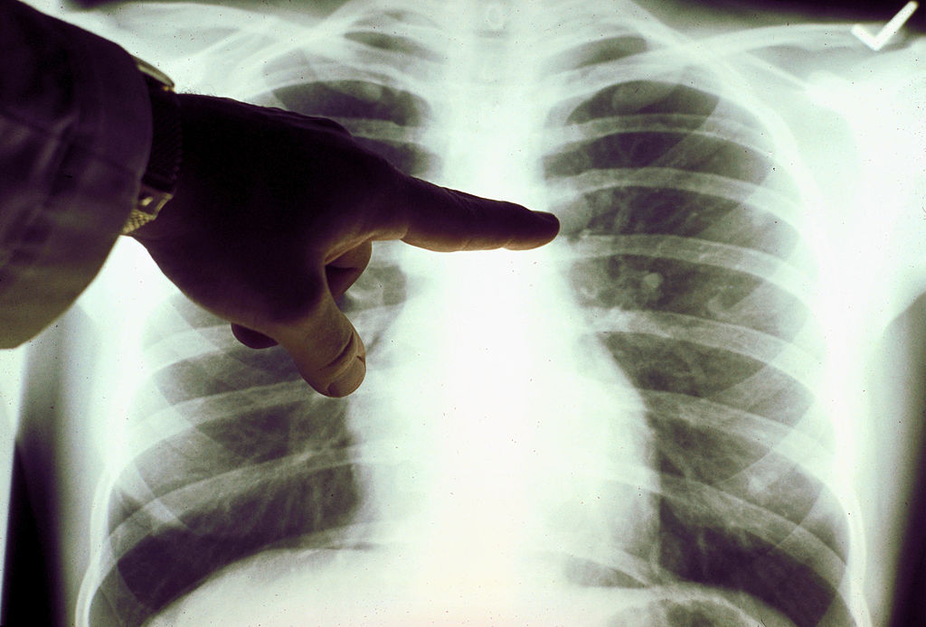 A view of a close up of a lung x-ray of a cigarette smoker in an undated photo.